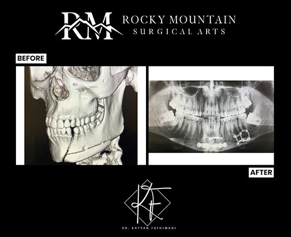jaw-fractures-subpage-ba-1