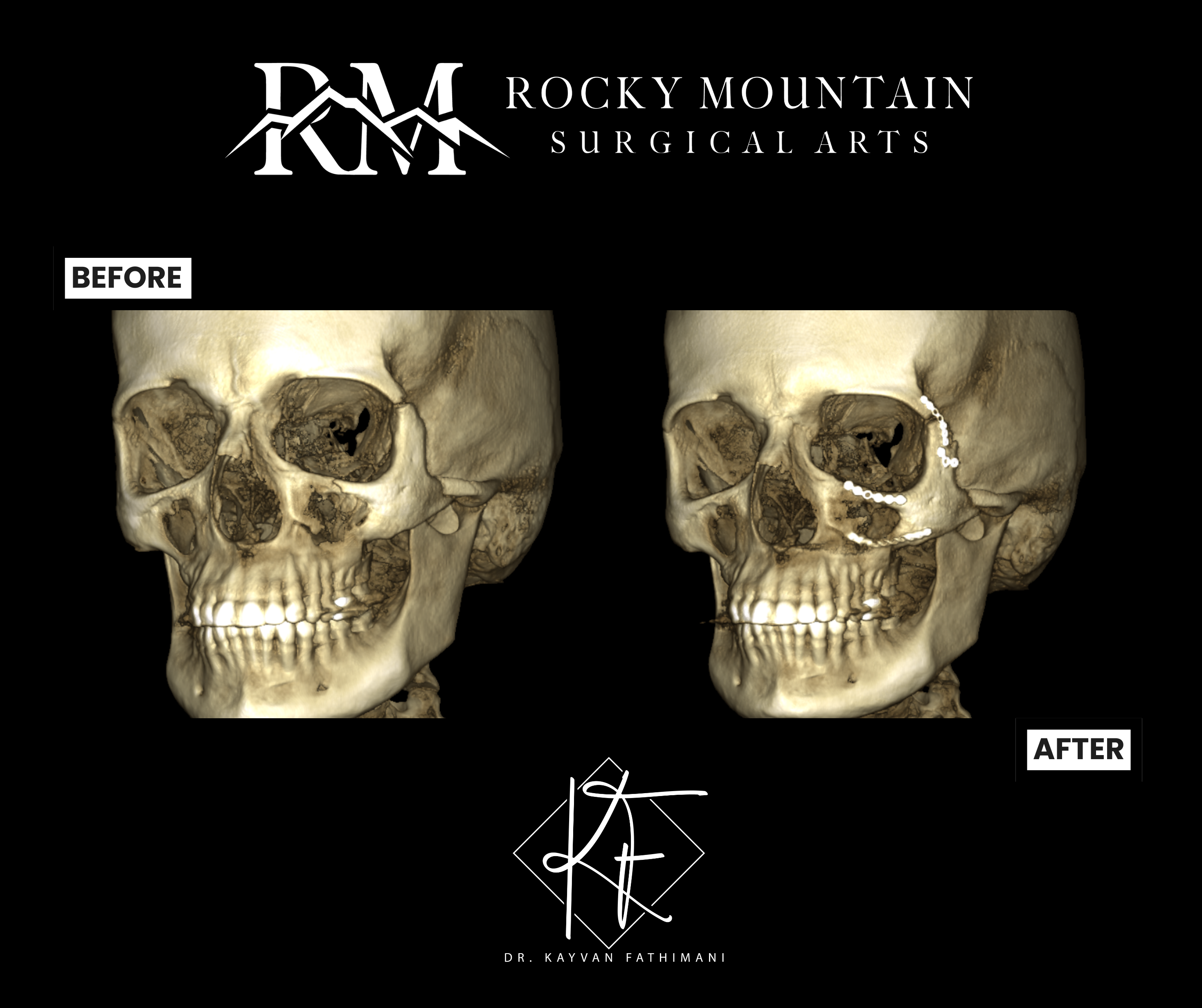 Facial Fractures (3b)