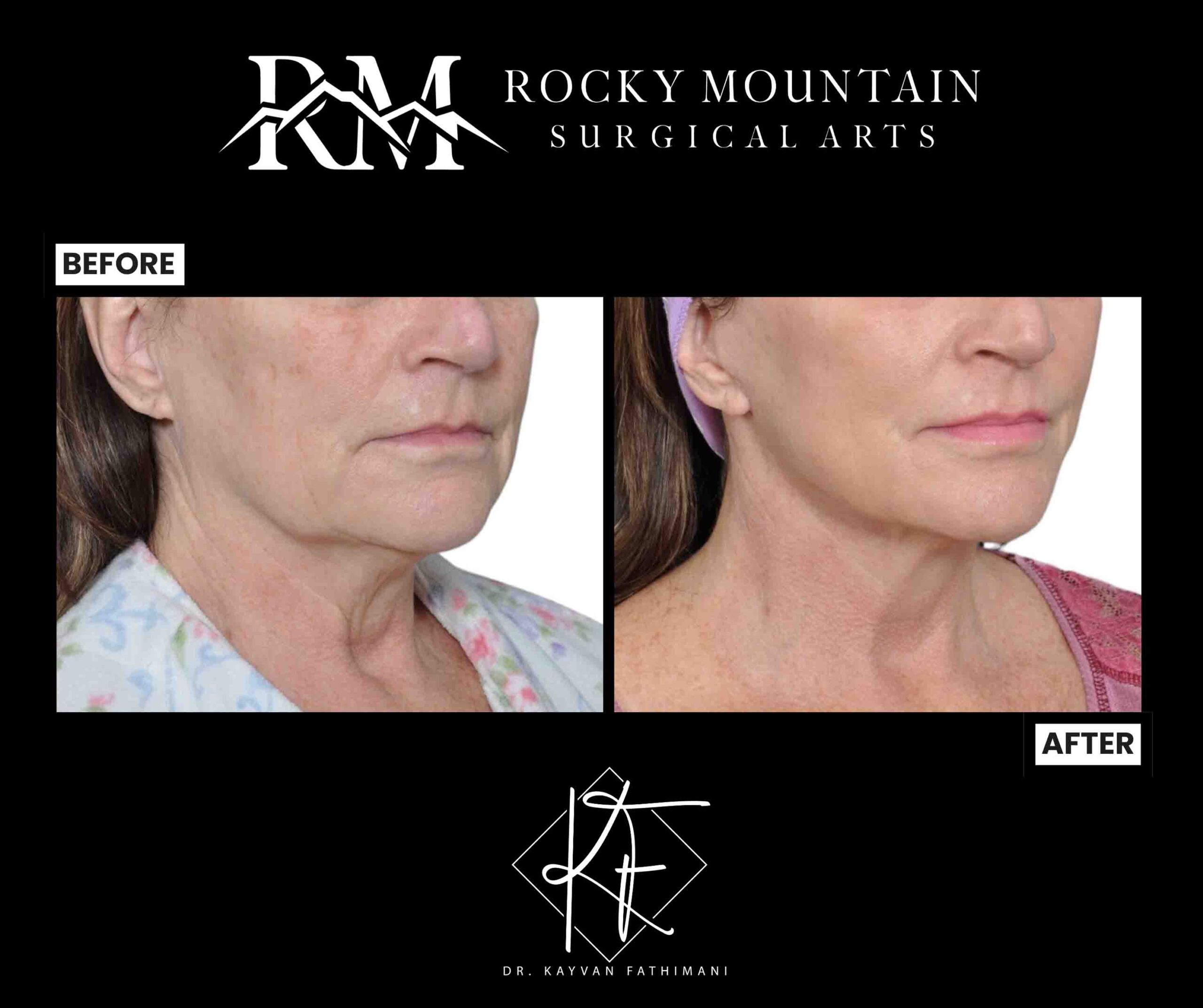 facelift-subpage-ba-1