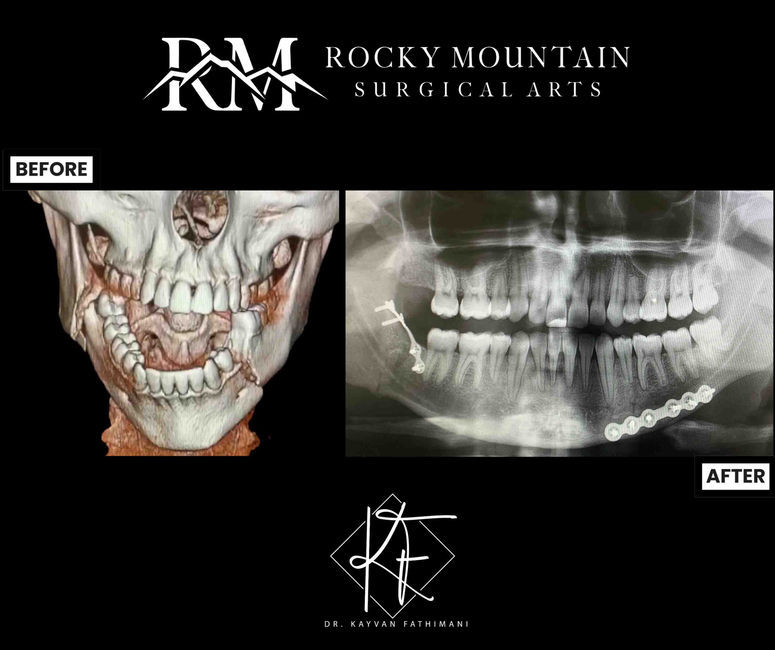 jaw-fractures-ba-5-a