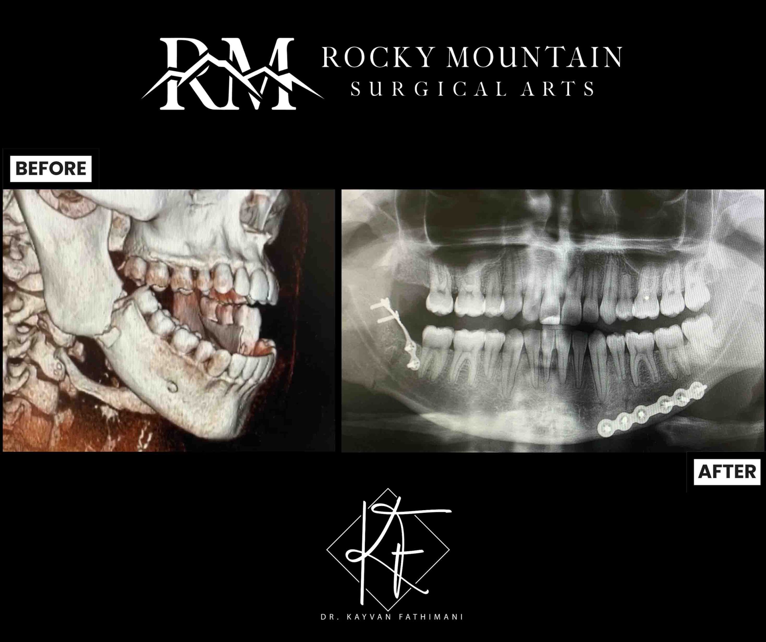 jaw-fractures-ba-5-b