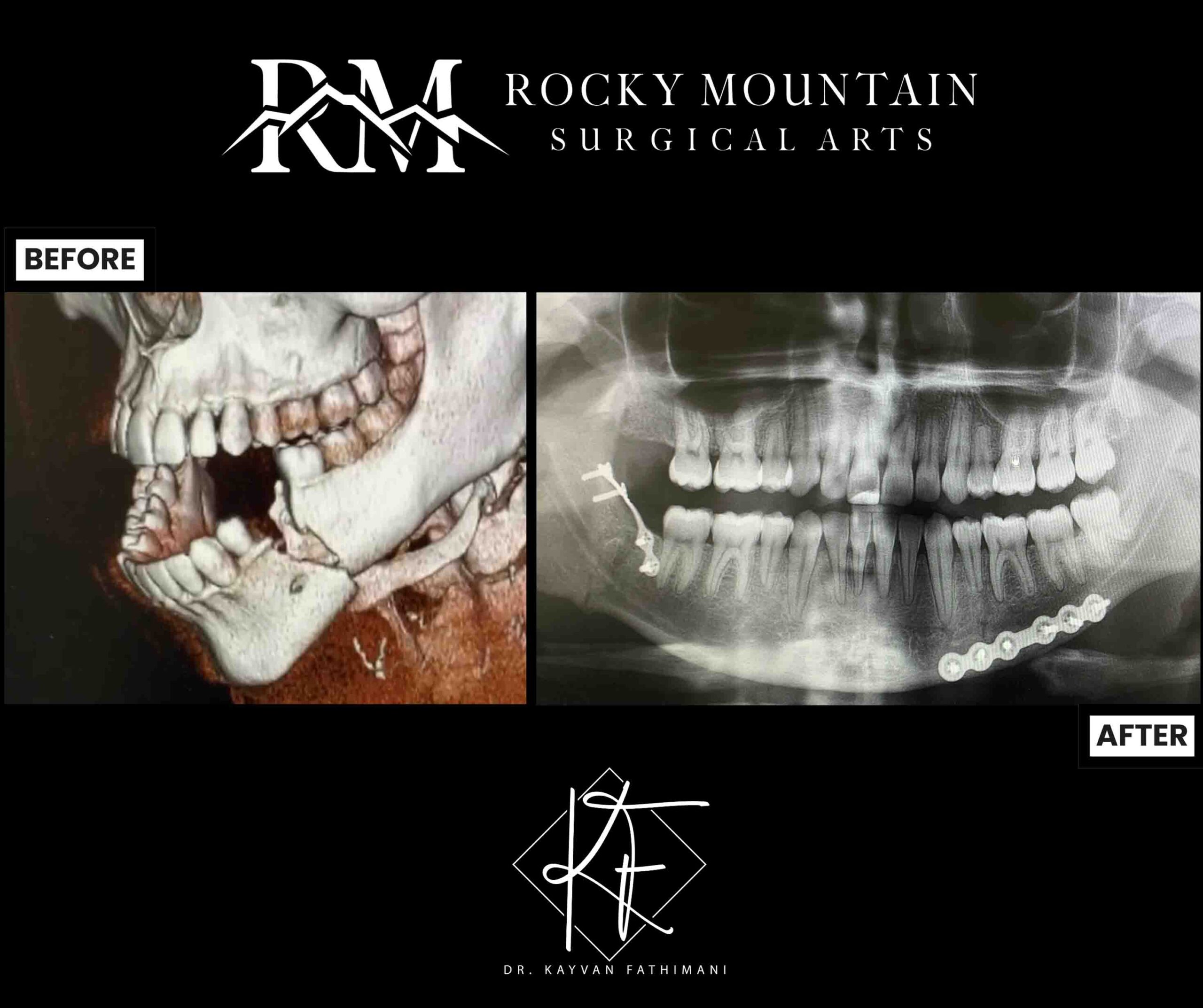 jaw-fractures-ba-5-c