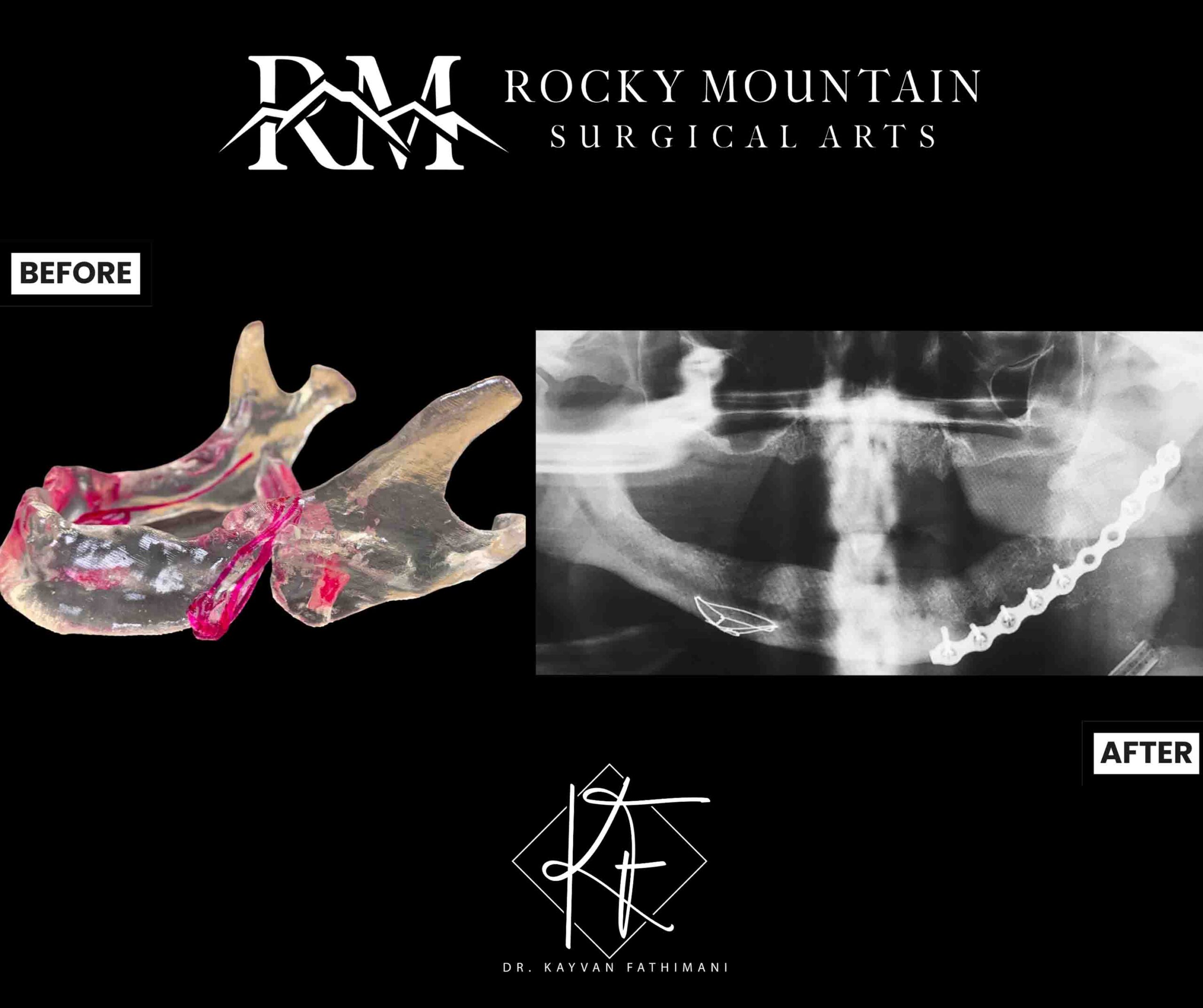 jaw-fractures-ba-6-a
