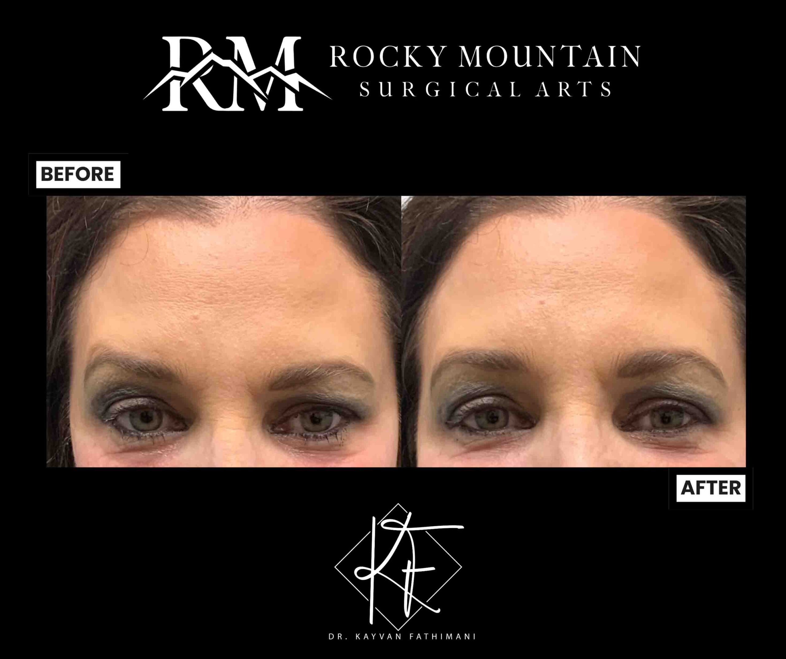 neuromodulators-botox-ba-subpage-1