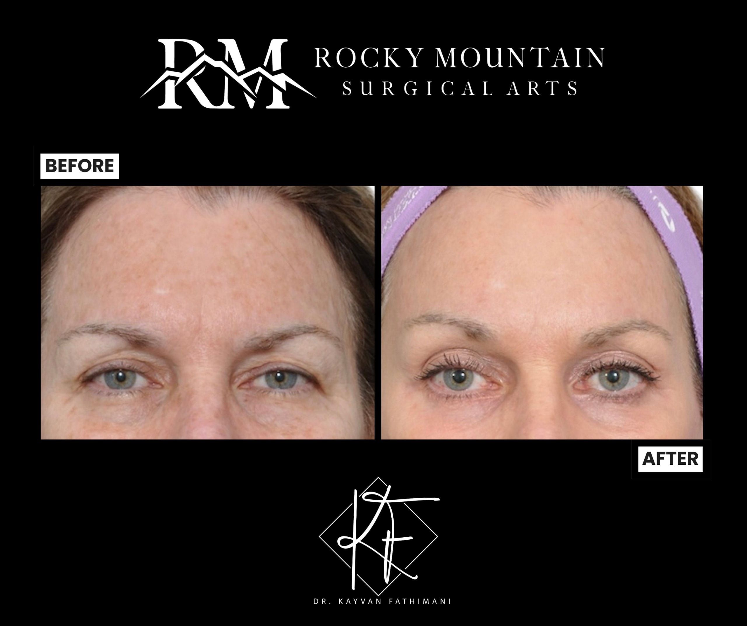 eyelid-brow-and-laser-1