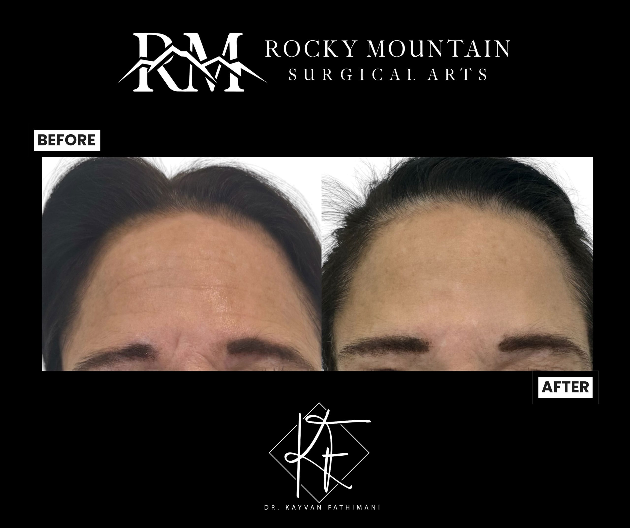 neuromodulators-botox-ba-2-scaled