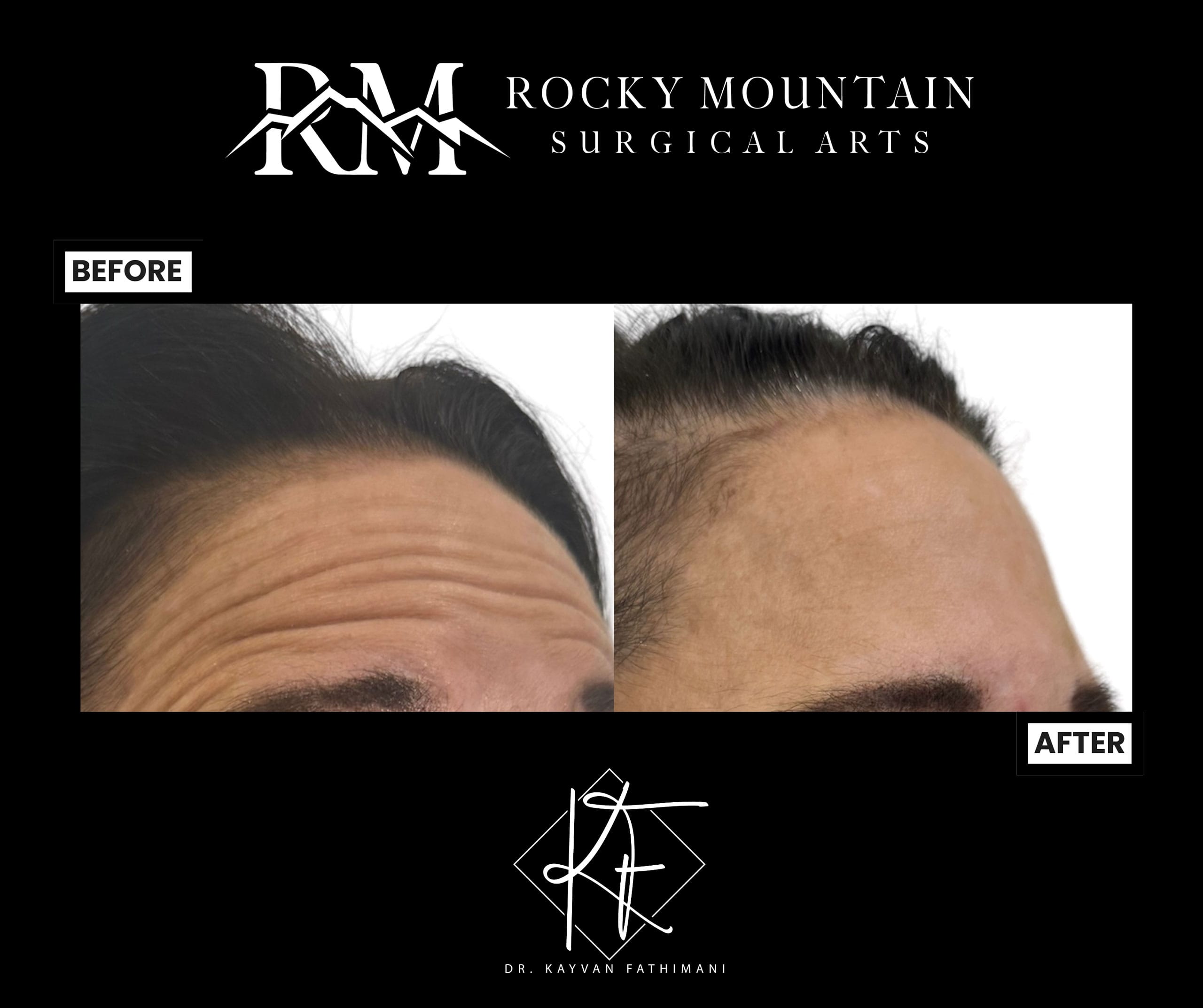 neuromodulators-botox-ba-3-scaled