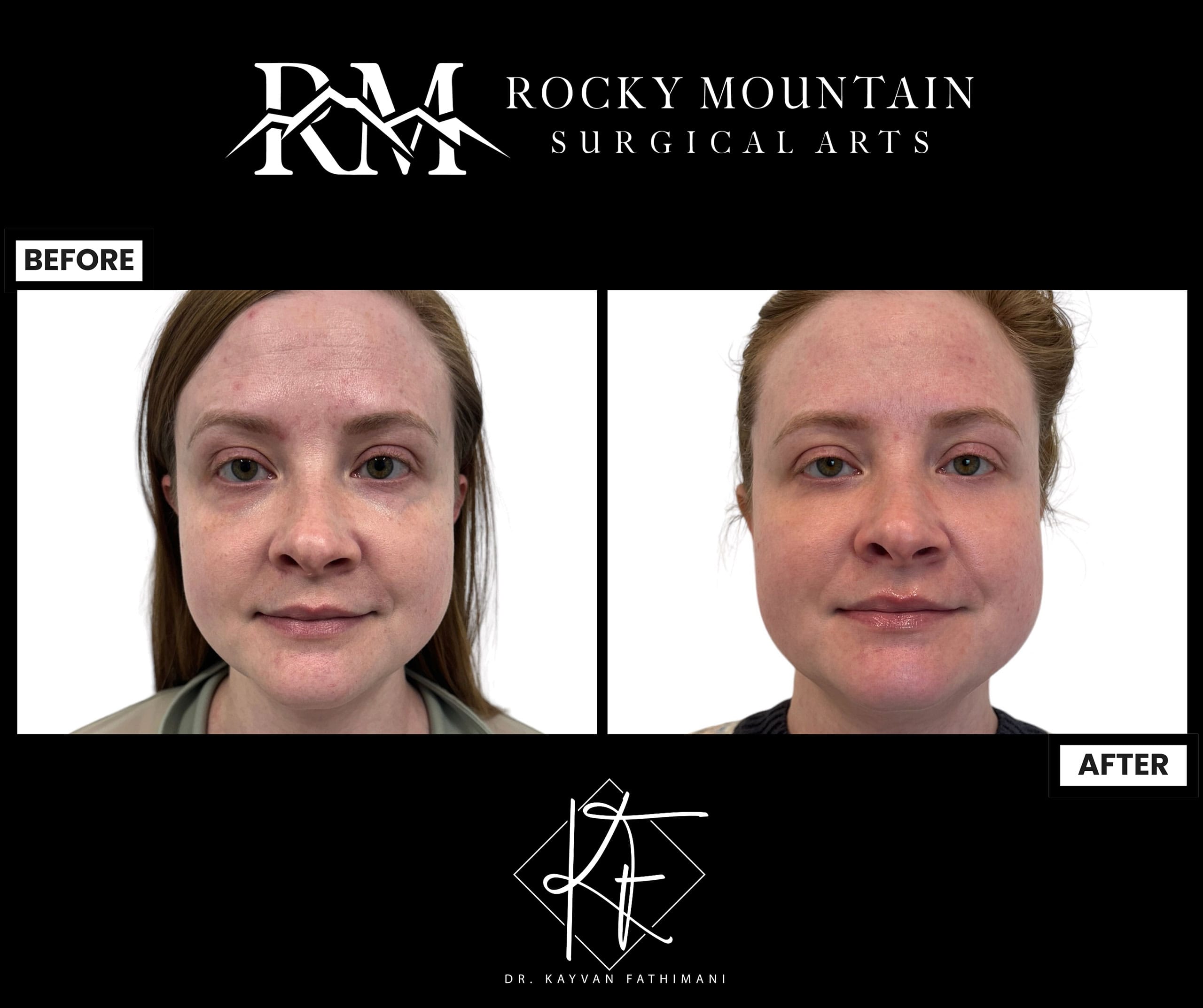 Non-Surgical-Skin-Rejuvenation-1-3