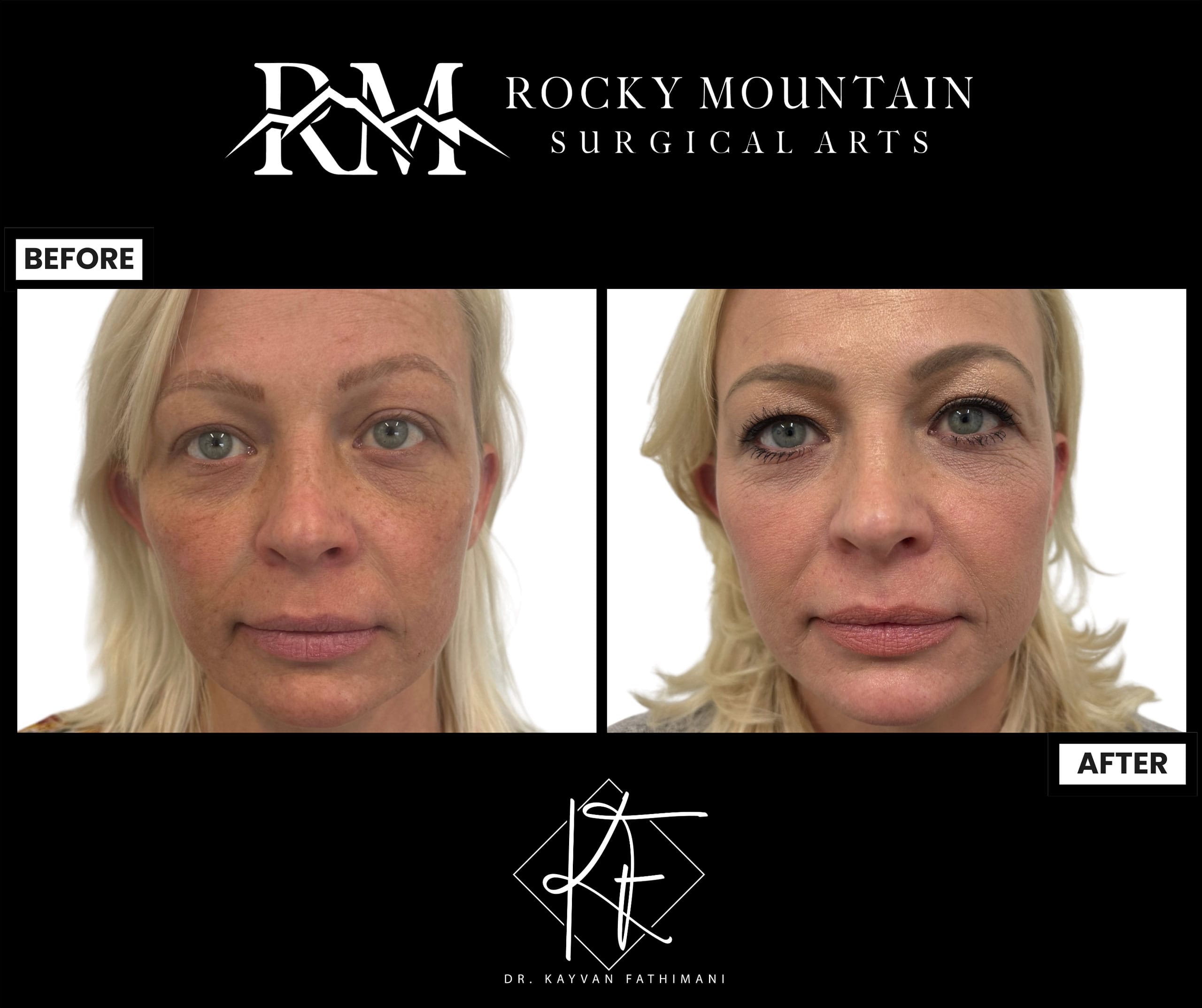 Non-Surgical-Skin-Rejuvenation-2-2