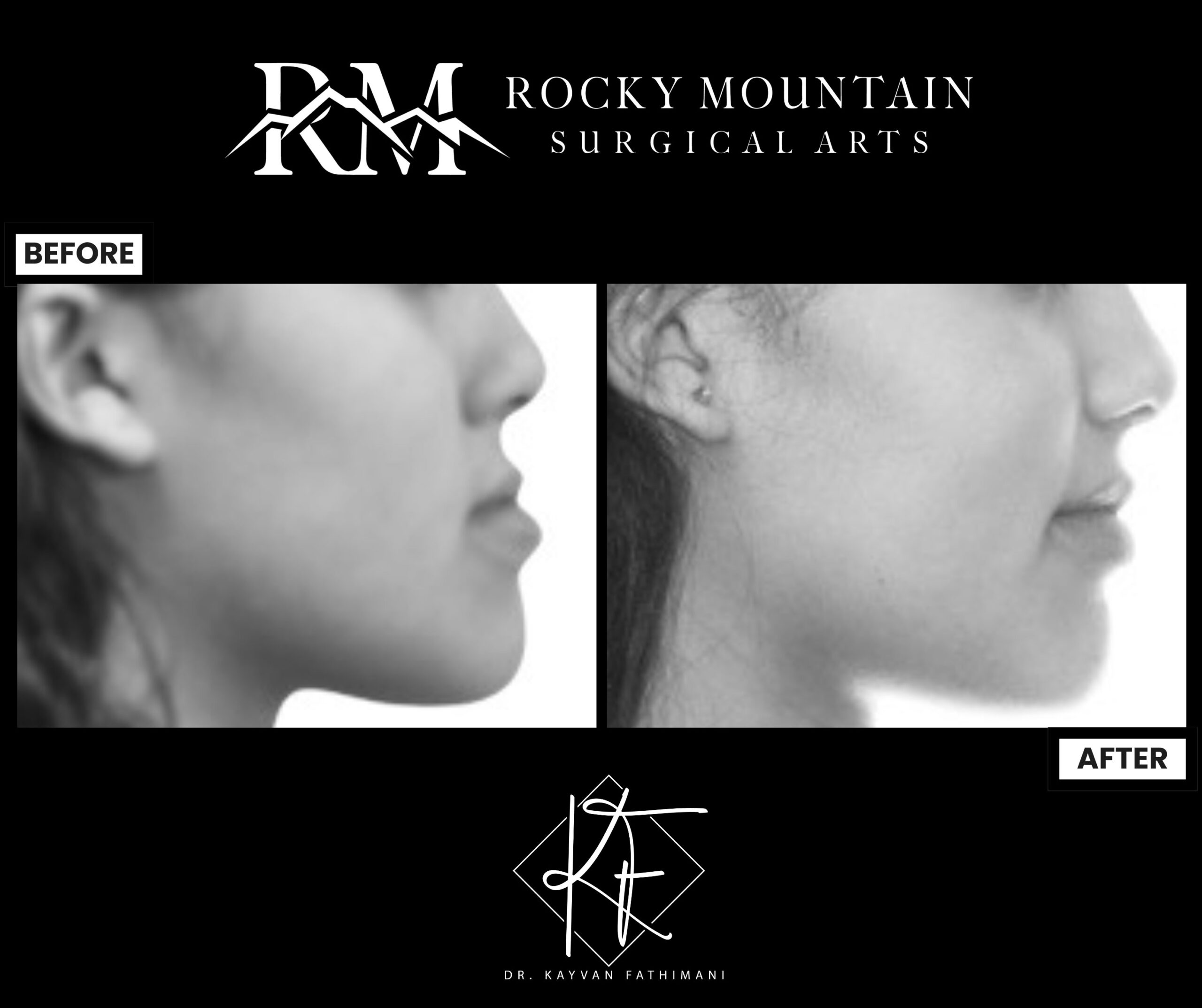 Corrective-Jaw-Surgery-Gallery-and-Genioplasty-Gallery-15