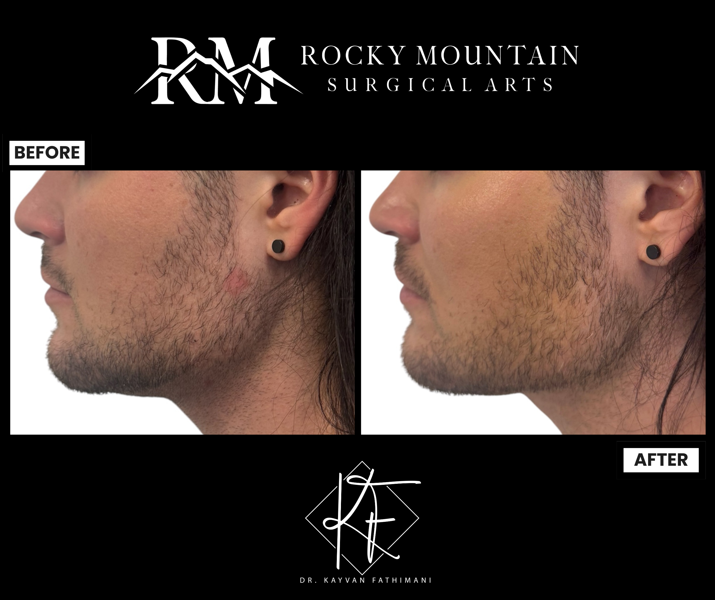 FaceTite, M8x2-2.png.