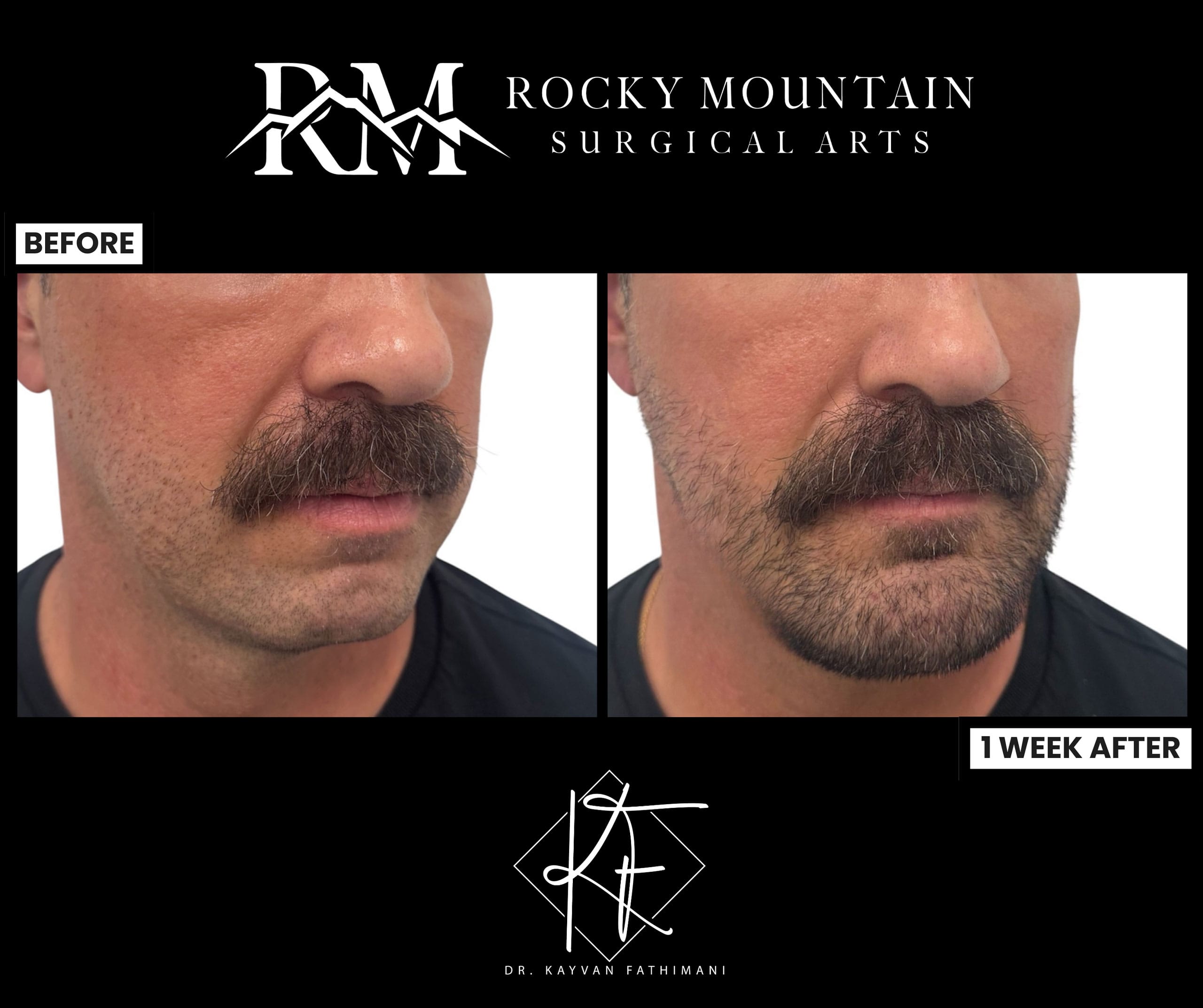 chin-implants-updated-1a