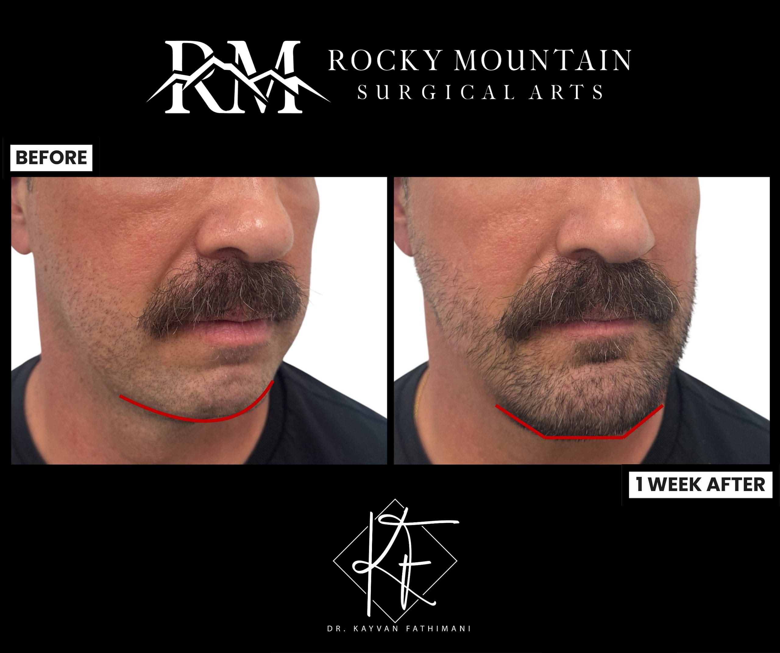 chin-implants-updated-1c