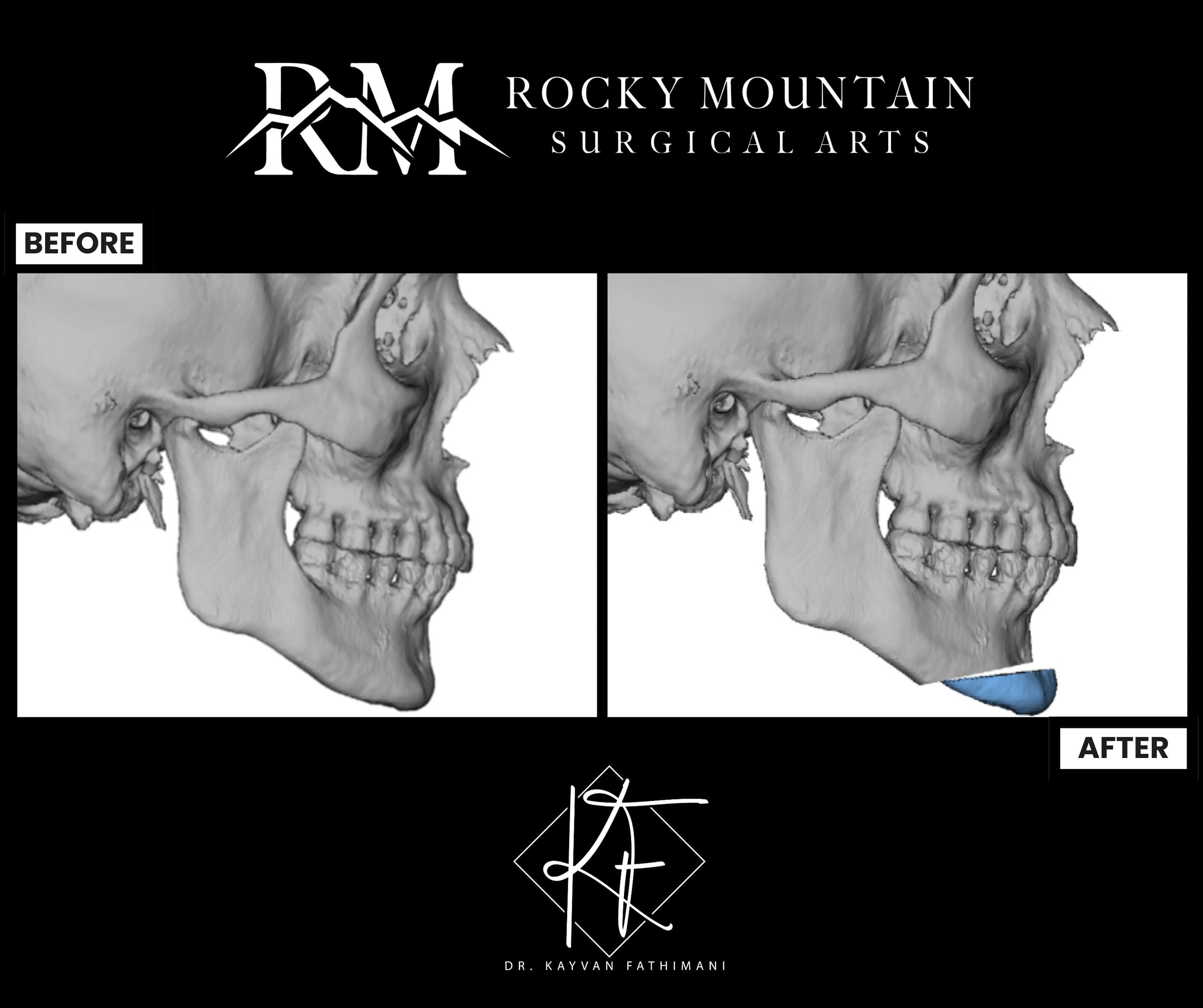 genioplasty-surgical-planning-1a