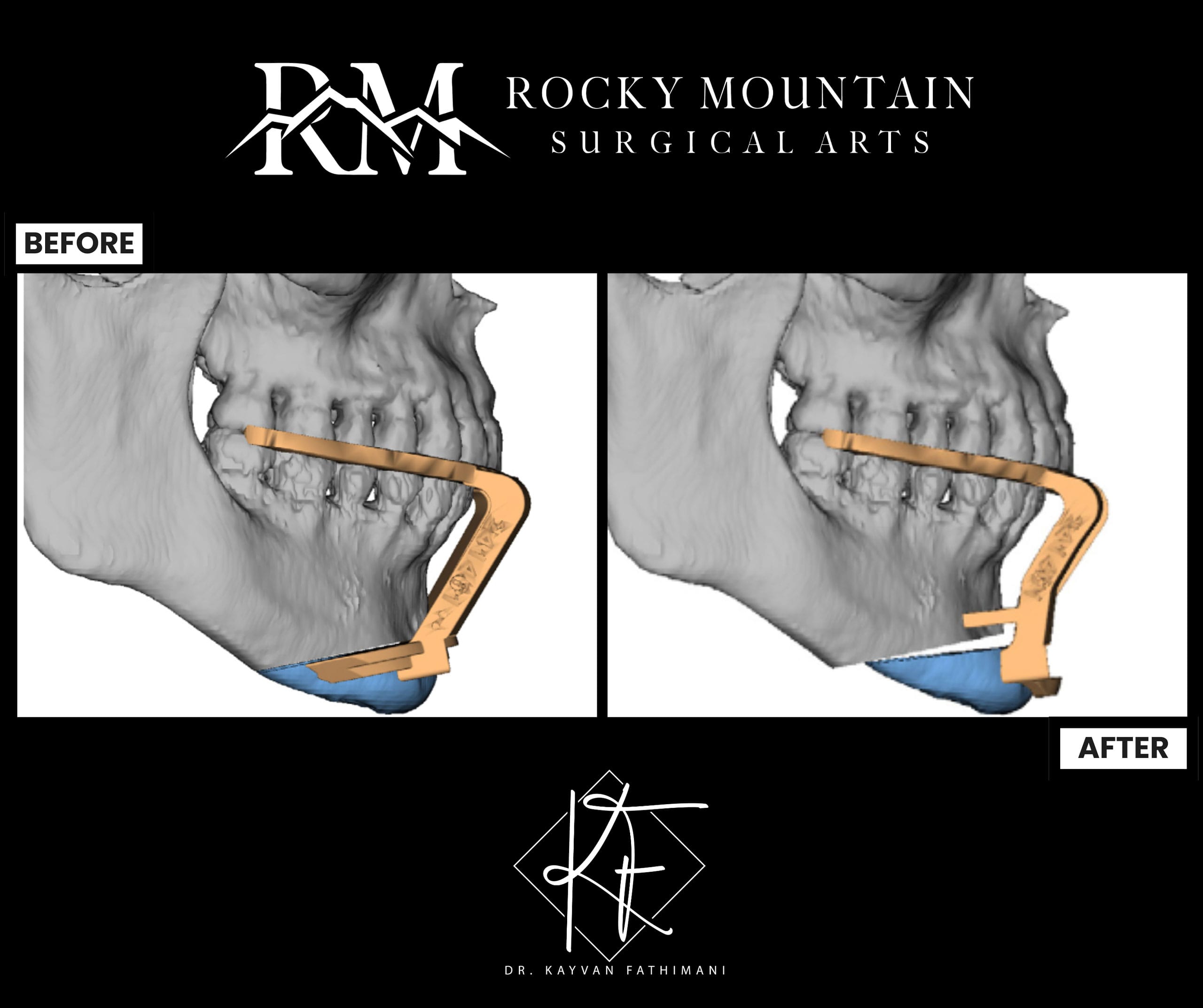 genioplasty-surgical-planning-1b