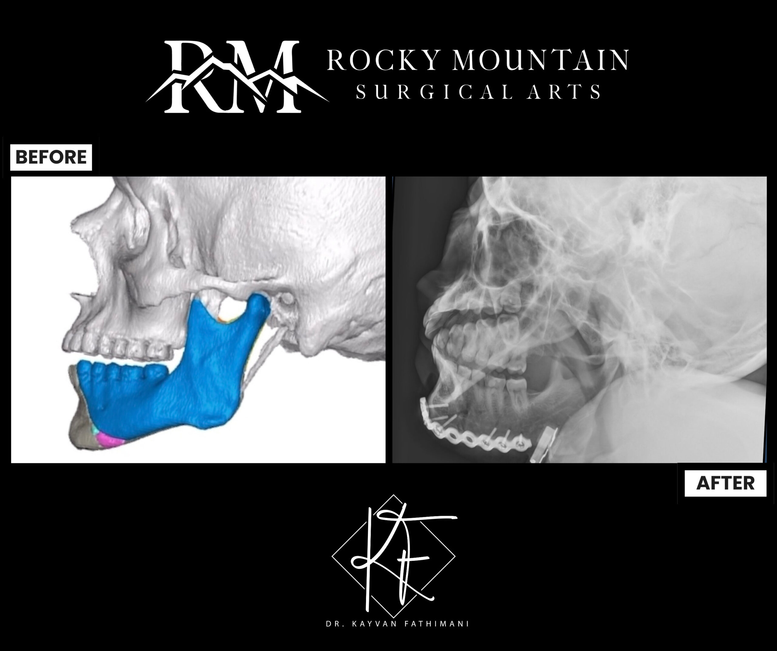 facial-jaw-fracture-14