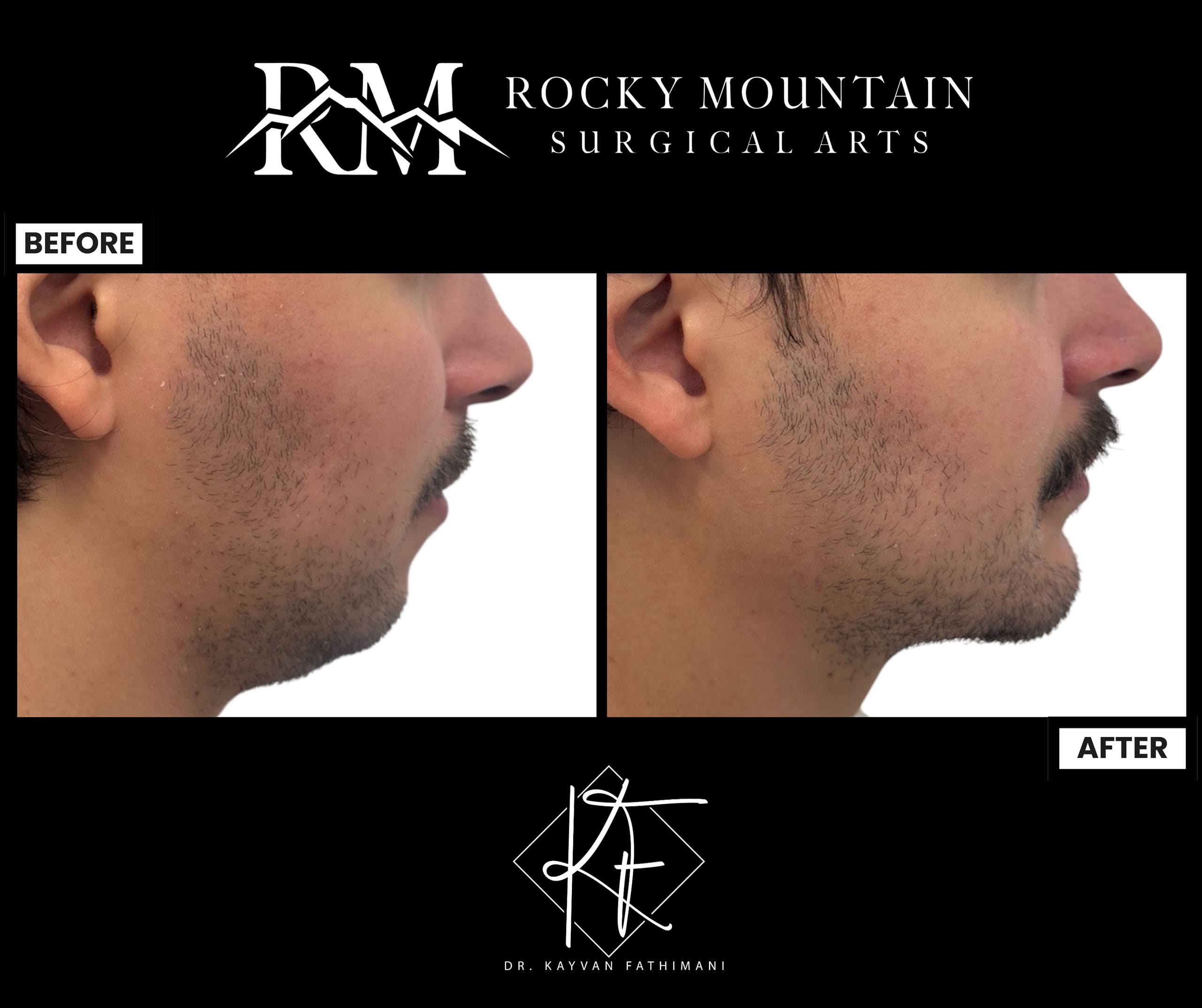 facial-implant-7a