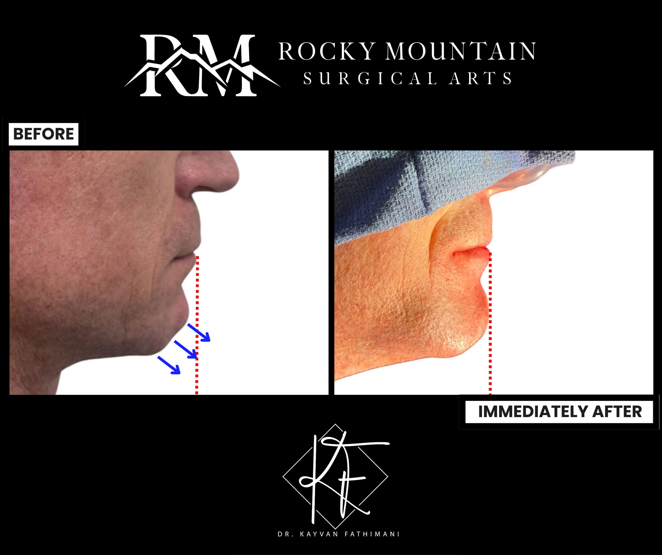 genioplasty-ba-20 before and after genioplasty