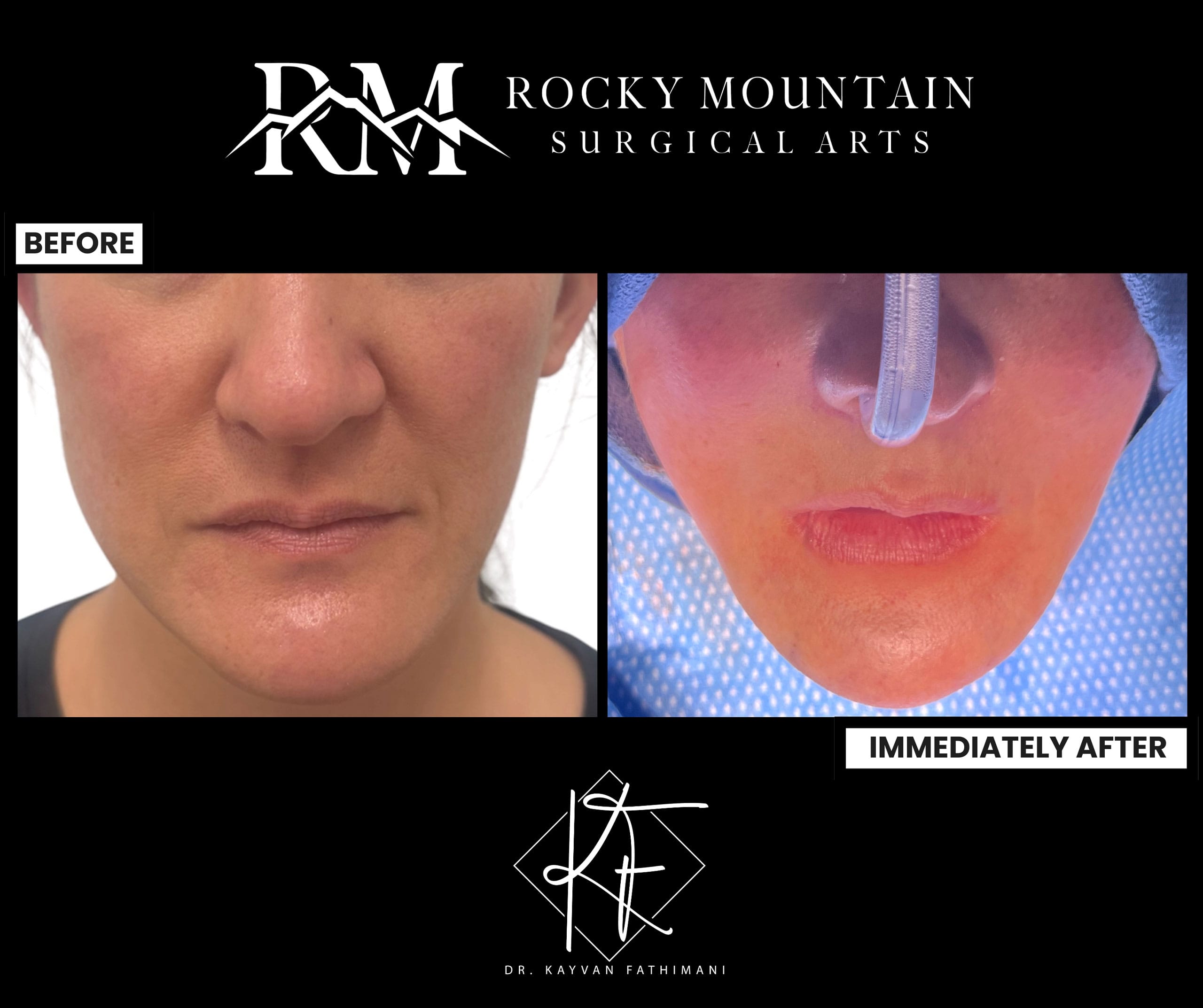 genioplasty-ba-21b before and after genioplasty