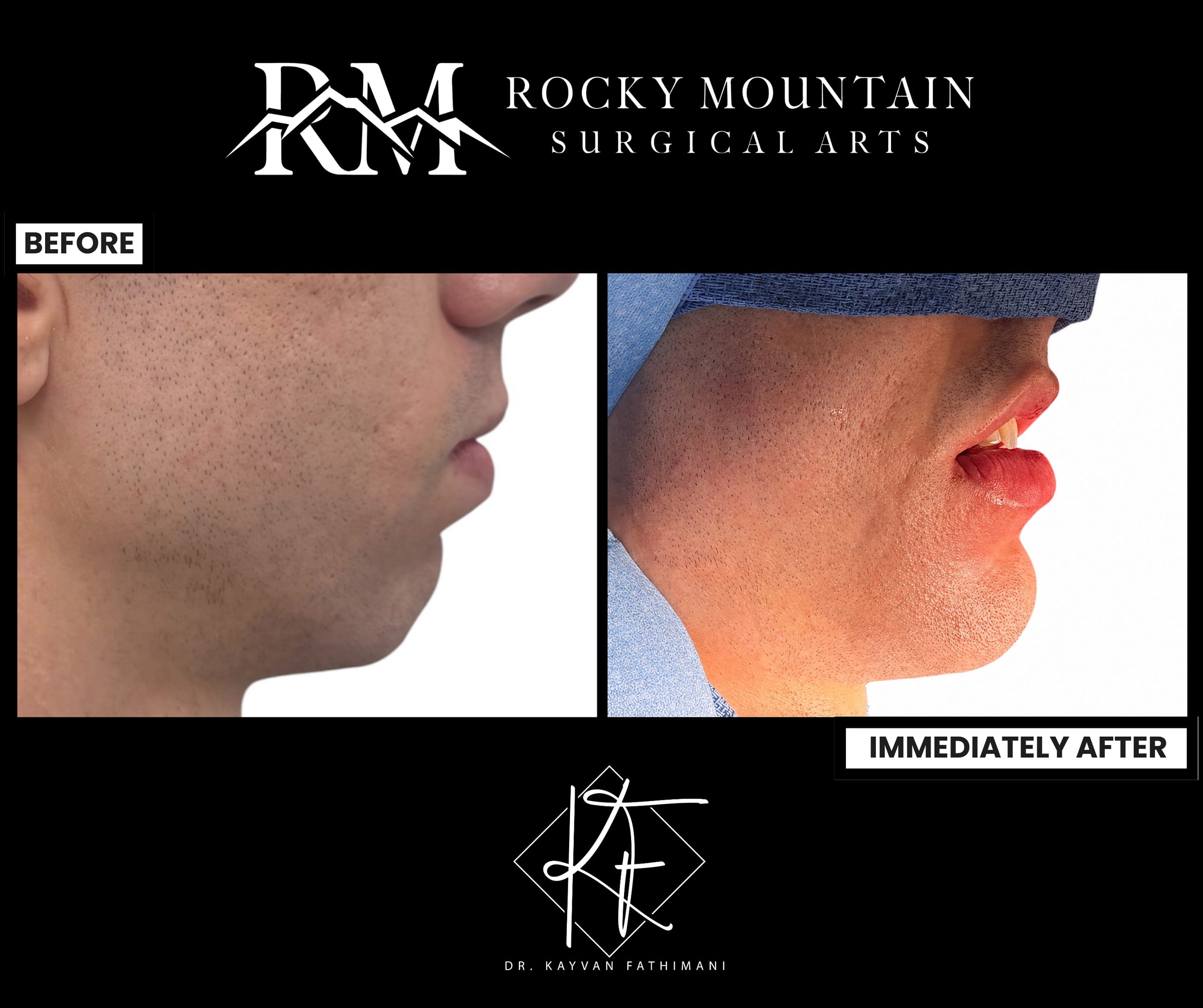 rmsa-genioplasty-ba